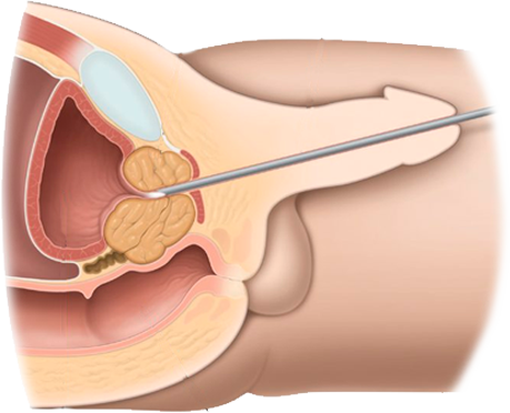Resección transurectal de próstata